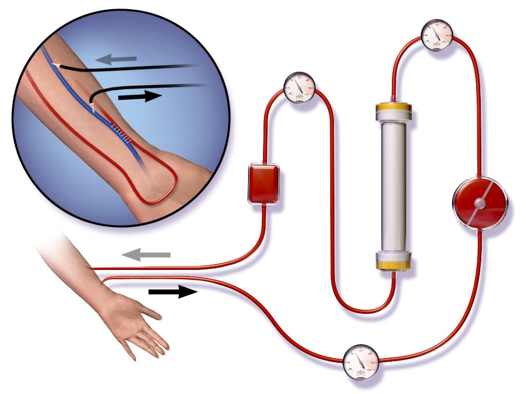Dialysis Care